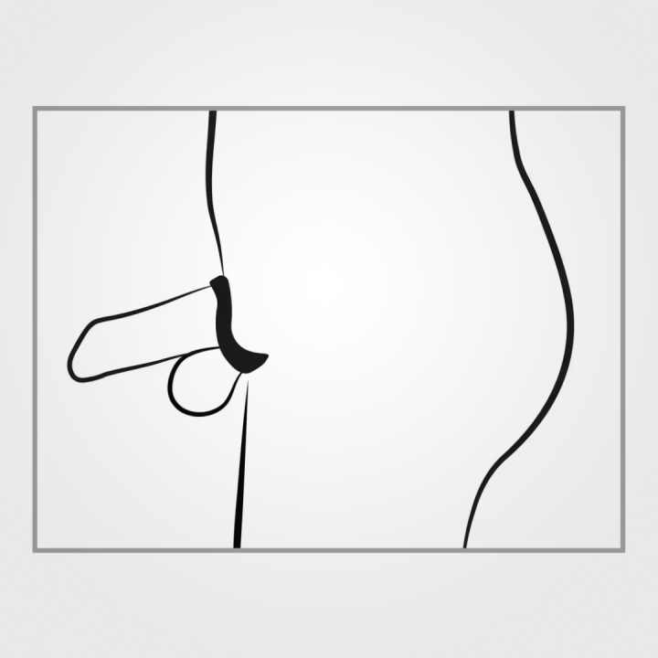 Dilator Penis Cage - Image 13